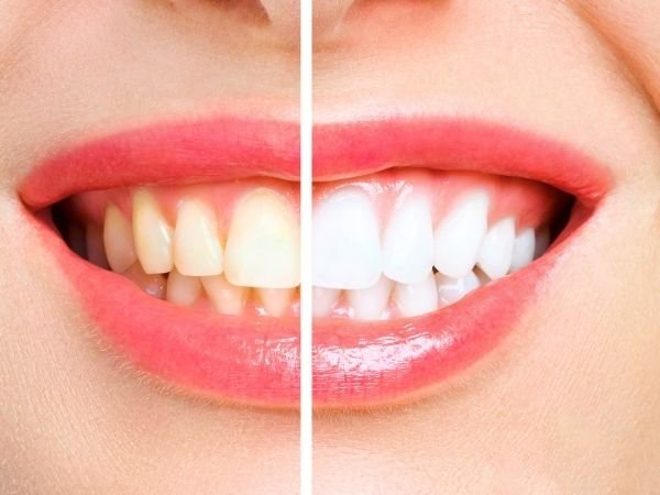 Estética dental